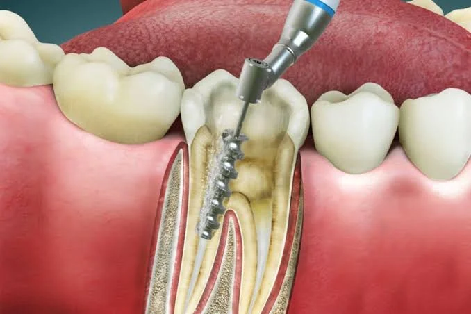 Dentist reassuring a patient before root canal treatment