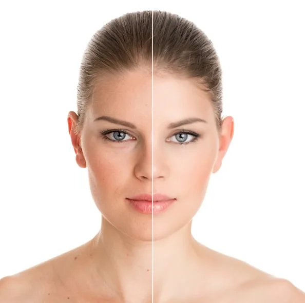 Skin Rejuvenation treatment
